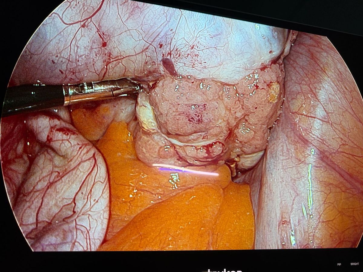 Low grade serous ovarian tumour — laparoscopic view on Stryker monitor